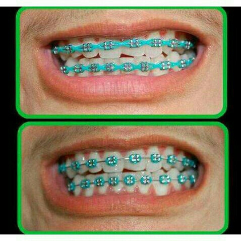 Behel Fashion 3