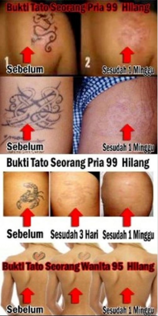 Penghilang Tato