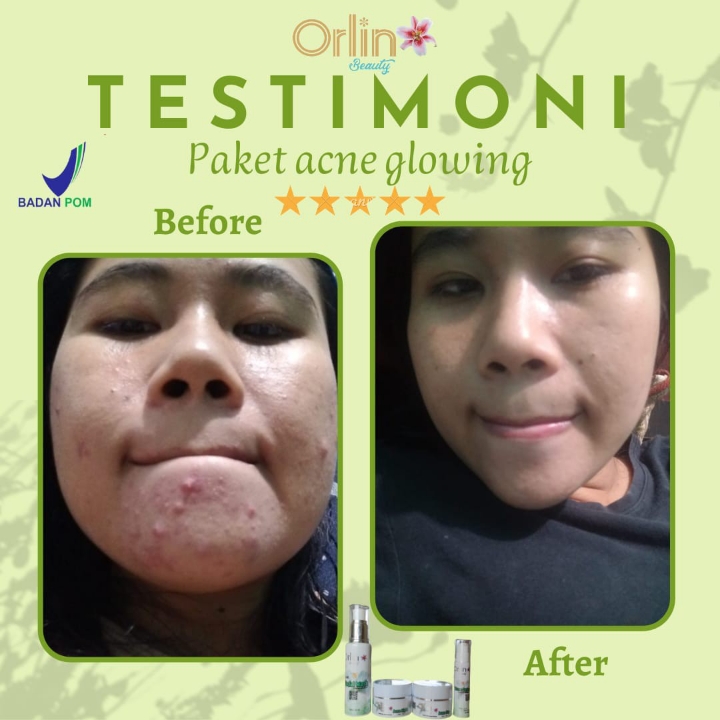 Acne Glowing Orlin Beauty  2