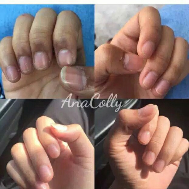 Anacolly 3