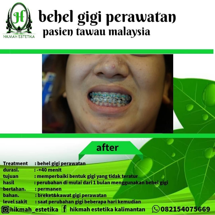 Behel Gigi Perawatan 