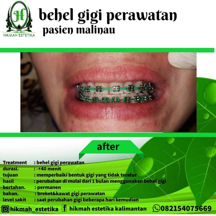 Behel Gigi Perawatan  2