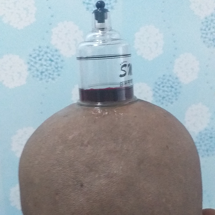 Bekam Kombinasi Pijat 120 Menit