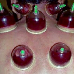 Bekam basah Rp 100 000