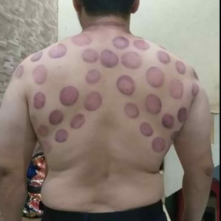 Bekam kering Punggung