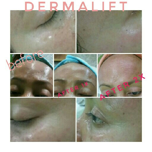 Dermalift Treatment