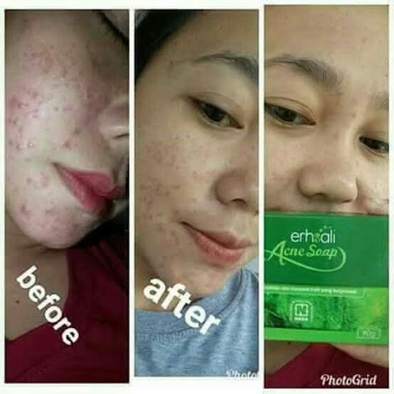 ERHSALI Anti Acne Soap 5