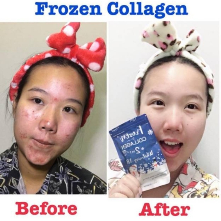 FROZEN COLLAGEN 3