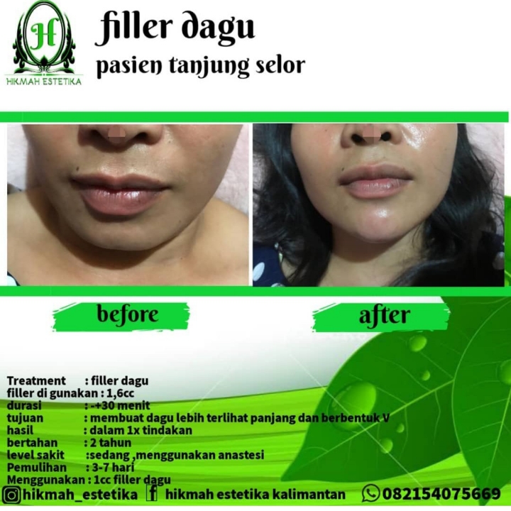 Filler Dagu