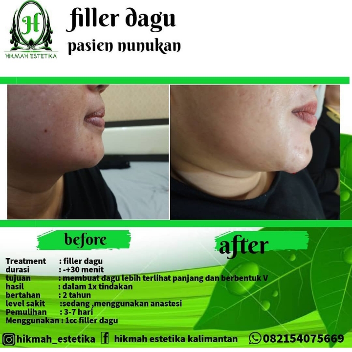 Filler Dagu 3