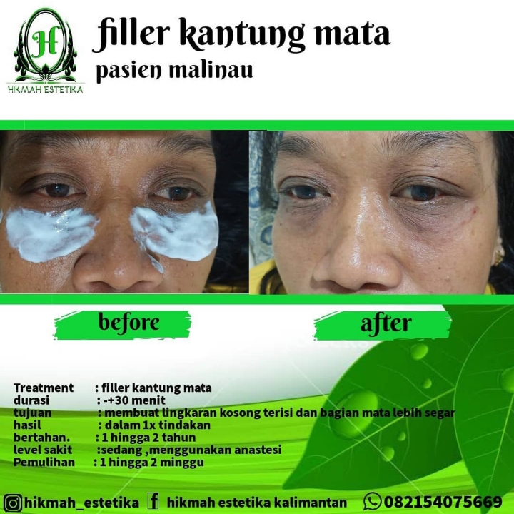 Filler Kantung Mata