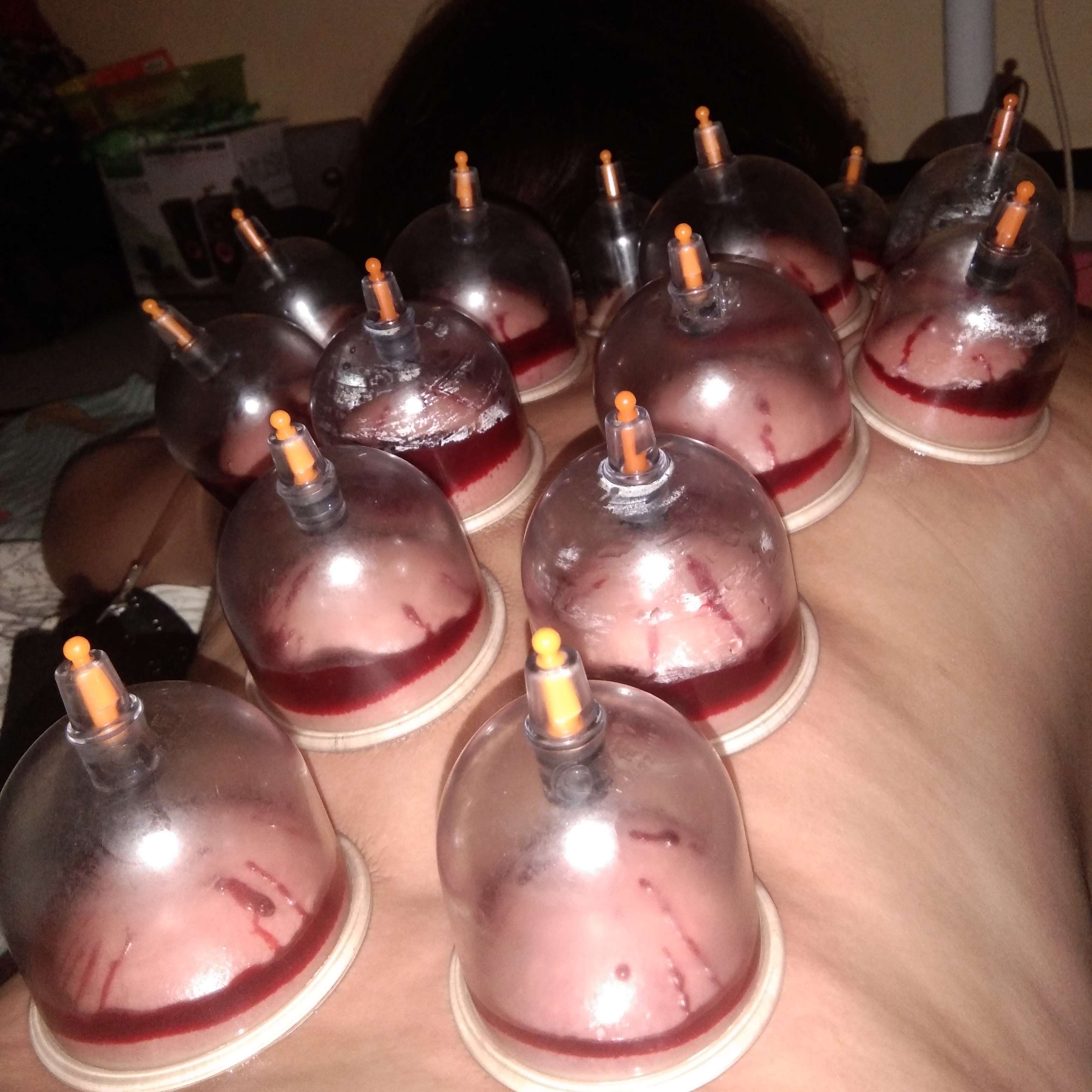 Full Bekam Basah