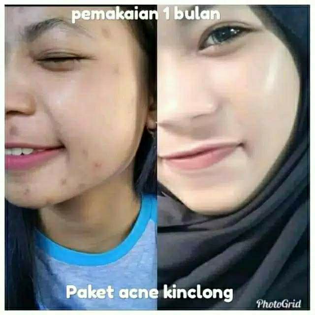 Glow beauty paket acne kinclong 3