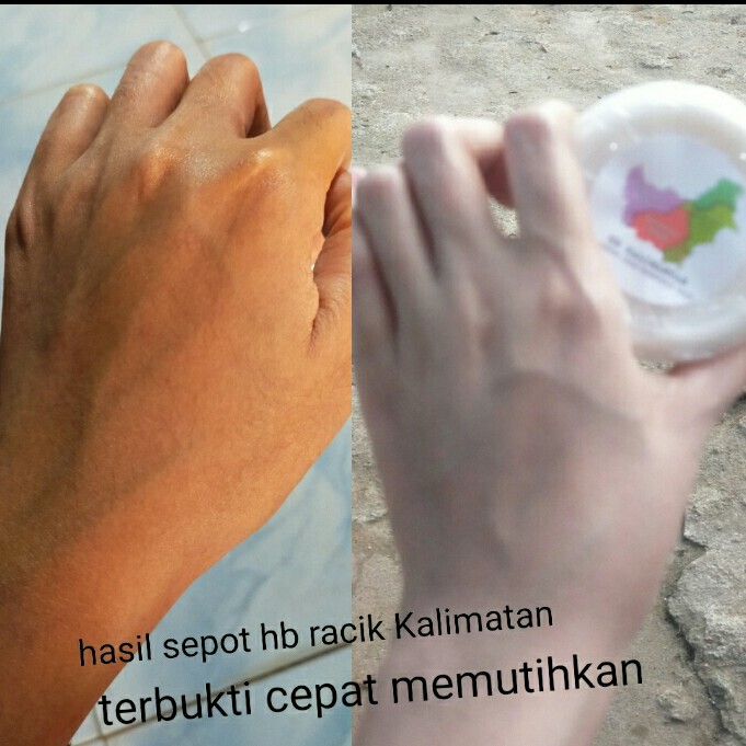 Hb Whitening Kalimantan