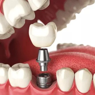 Implant gigi