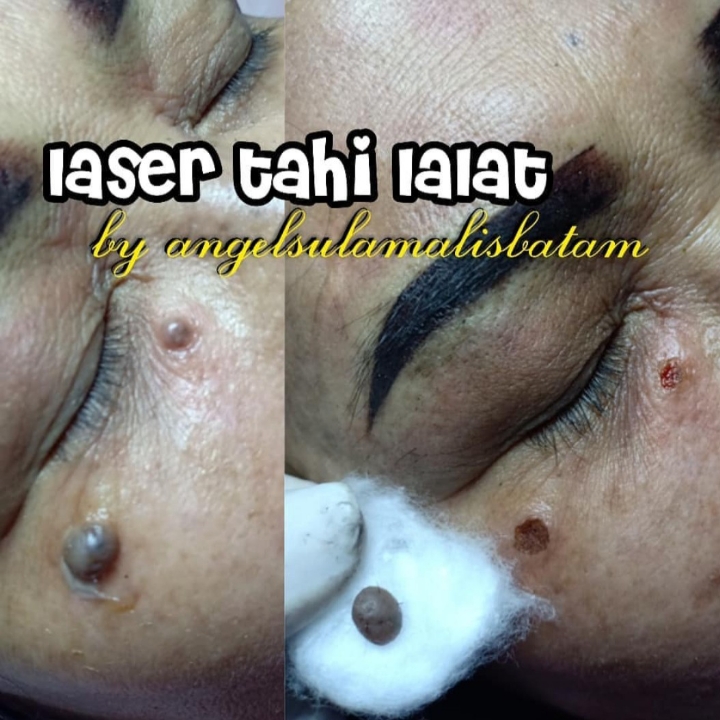 Laser Kulit Dan Tahilalat