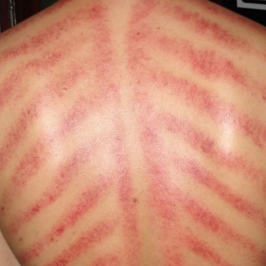 Light Massage  Dan Kerokan