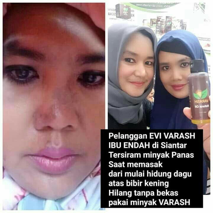 Muka Tersiram Minyak Panas Hilang Bekasnya Pakai Minyak Varash 