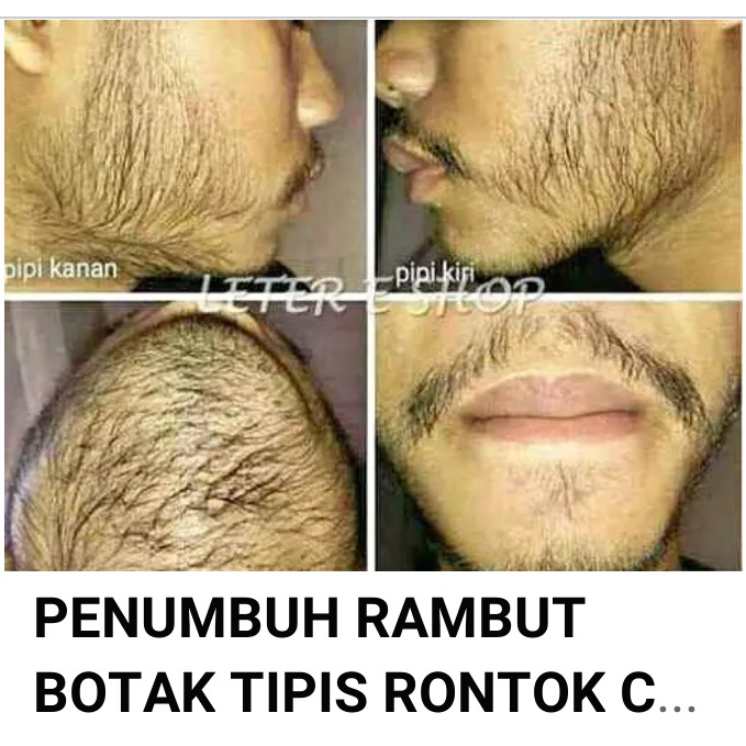 PENUMBUH RAMBUT