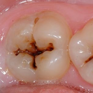 Penambalan Gigi Geraham Besar atau Kecil