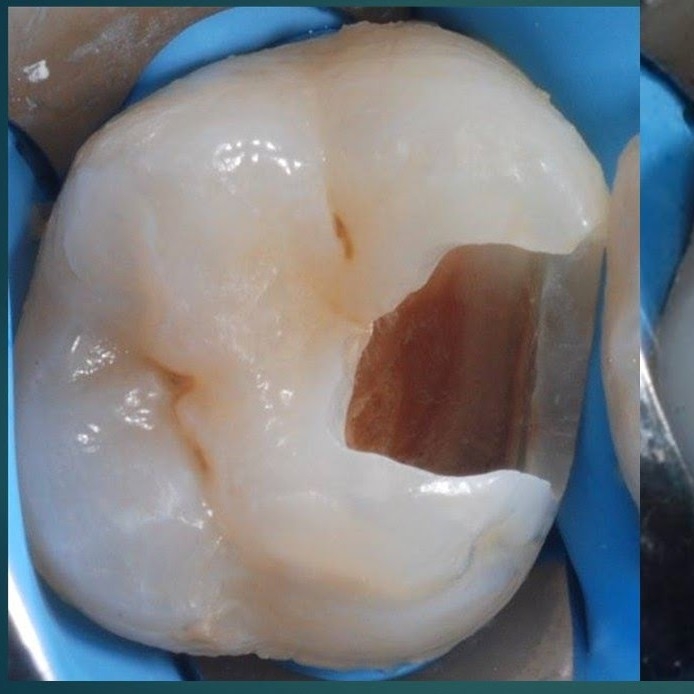 Penambalan Gigi Geraham Besar atau Kecil