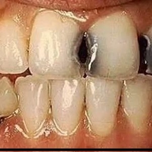 Penambalan Gigi Kampak Di Tengah-Tengah Gigi