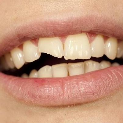 Penambalan Gigi Sompel