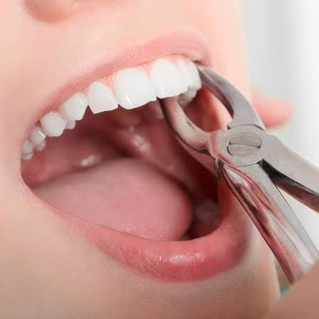 Pencabutan Gigi Graham Besar