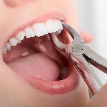 Pencabutan Gigi Kampak-Besar-Kelinci-paling depan