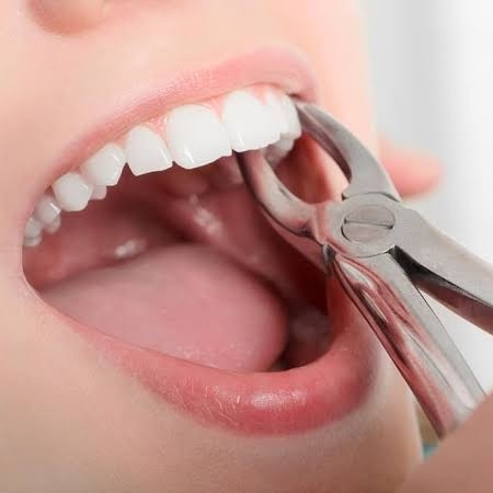 Pencabutan Gigi Taring-Seri