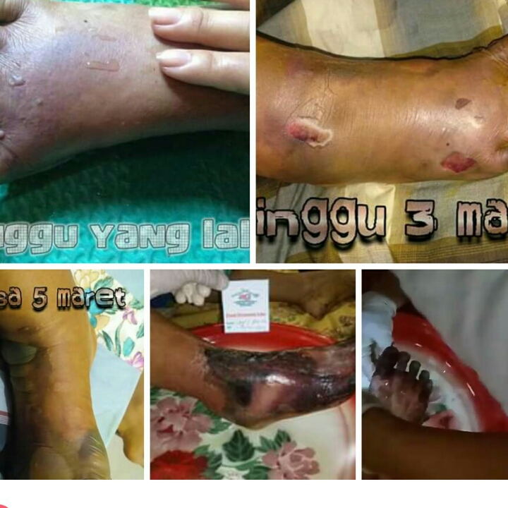 Perawatan Luka Moderen 5