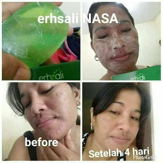 Sabun Erhsali NASA Acne