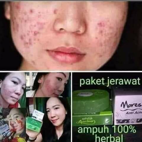 Sabun Erhsali NASA Acne 2