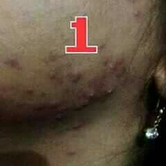 Sabun Muka Black Mayva Solusi Jerawat Membandel 
