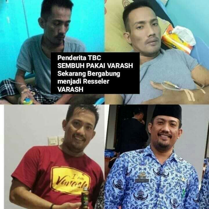 TERAPI TBC DENGAN MINYAK VARASH 