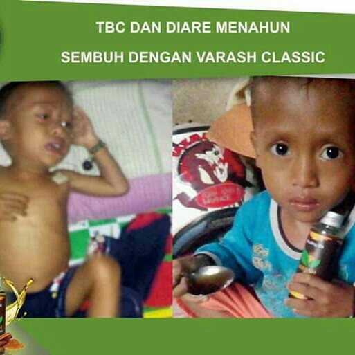 TERAPI TBC DENGAN MINYAK VARASH  2