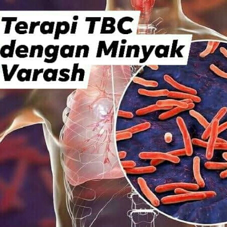 TERAPI TBC DENGAN MINYAK VARASH  3