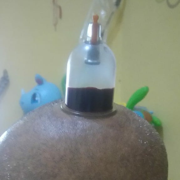 Terapi Stroke Ringan