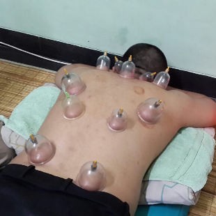 Terapi Bekam