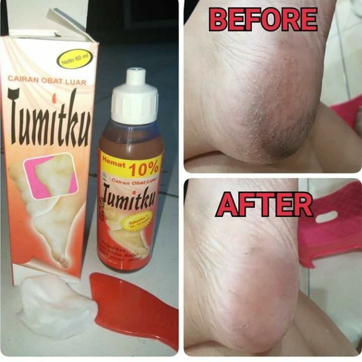 Tumitku Untuk Kaki Pecah-pecah