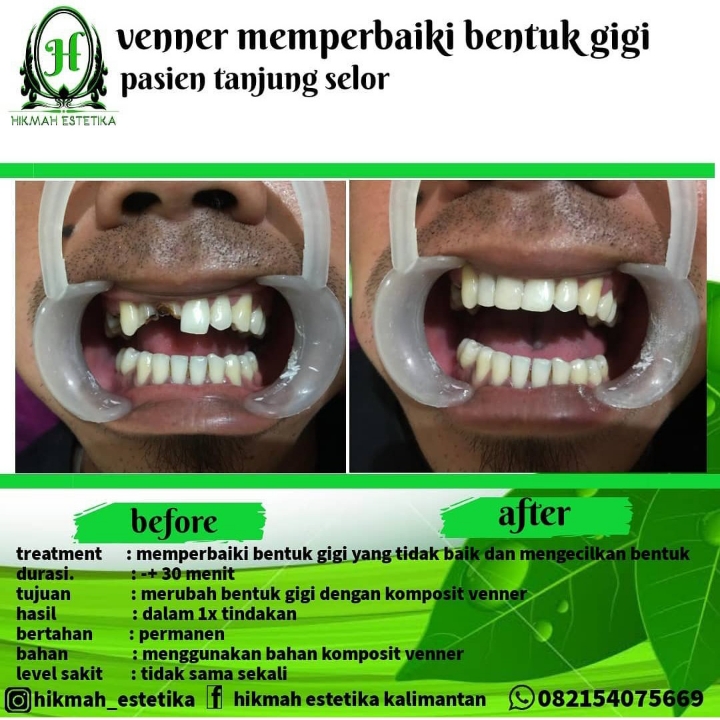 Venner Gigi Ompong 2