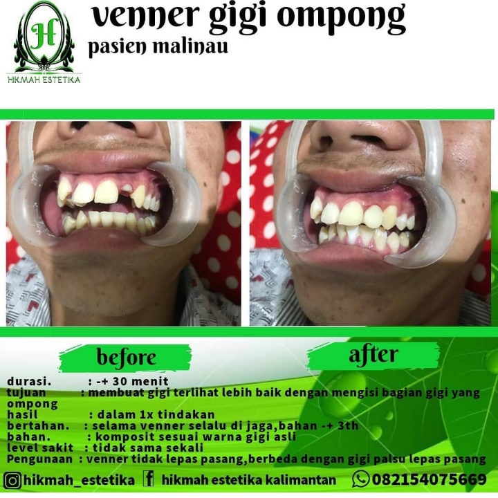 Venner Gigi Ompong 3