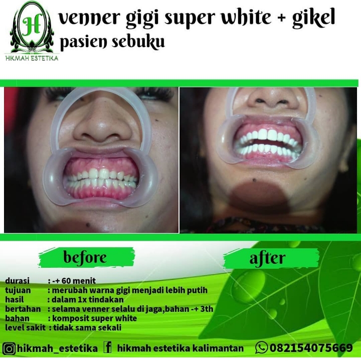 Venner Gigi Putih