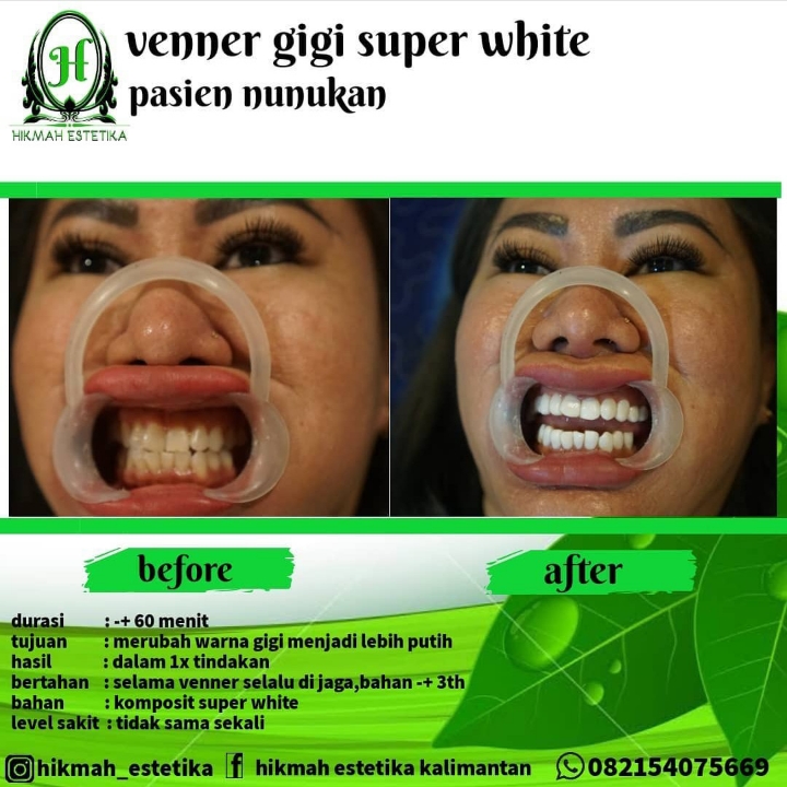 Venner Gigi Putih 3