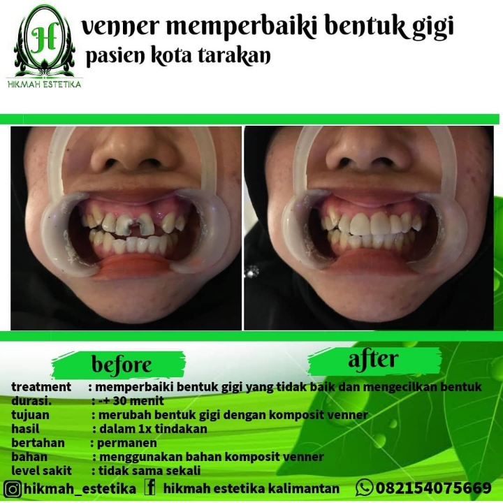 Venner Memperbaiki Bentuk Gigi