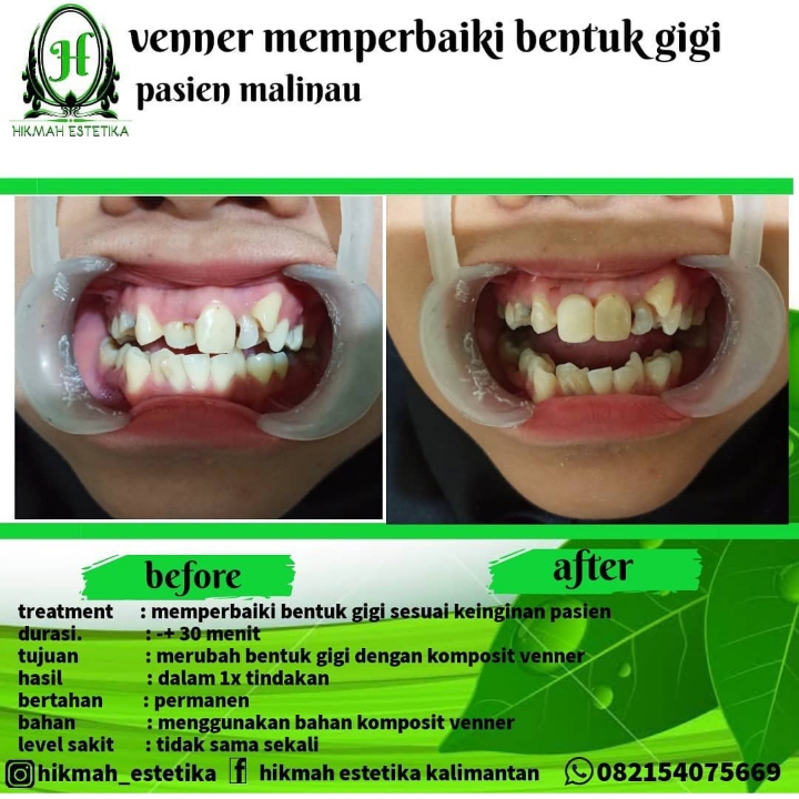 Venner Memperbaiki Bentuk Gigi 3